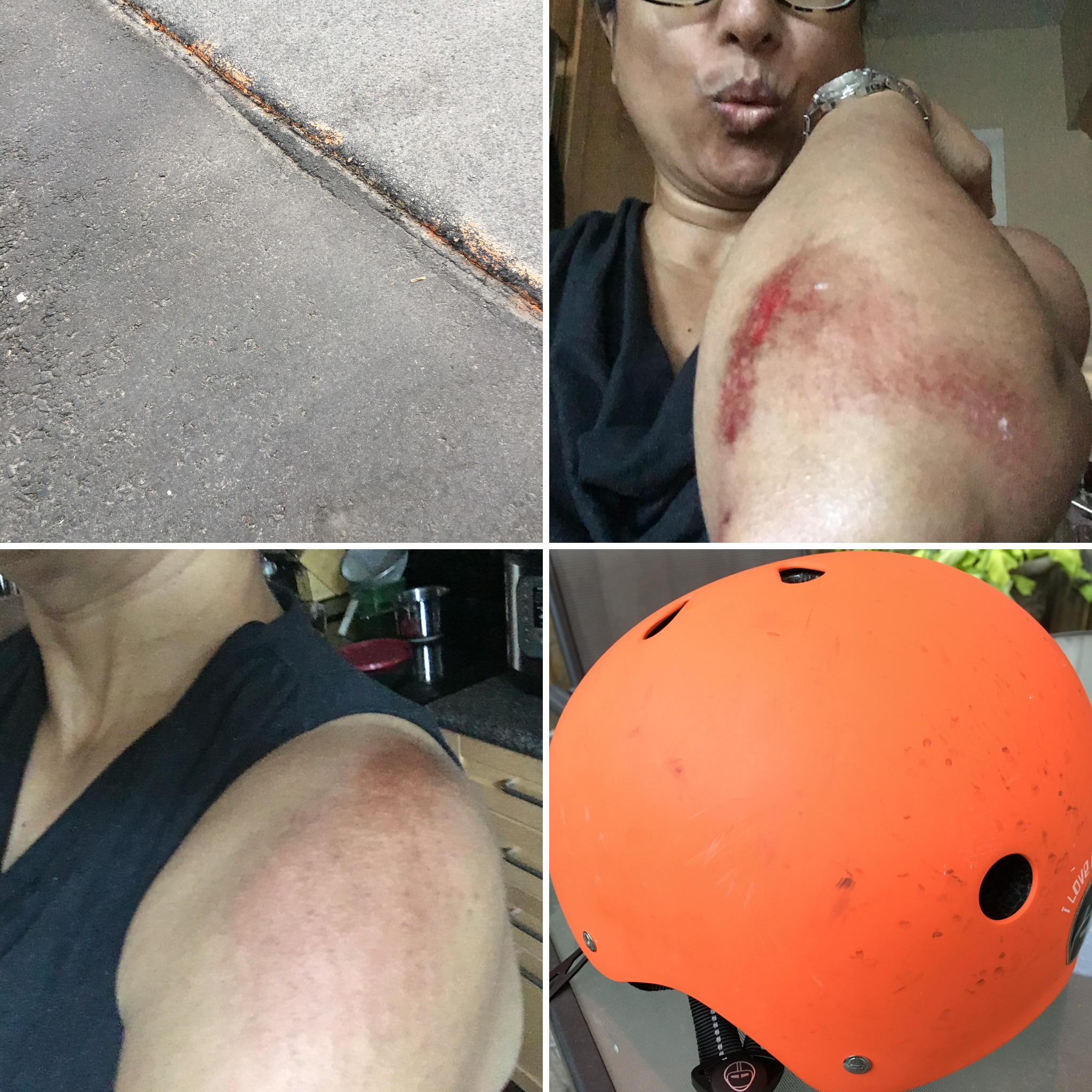 Collage showing the rut that my tire hit;Road rash on may Arm; Road Rash on my Shoulder; the Helmet that saved my life